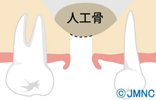 ソケットリフト