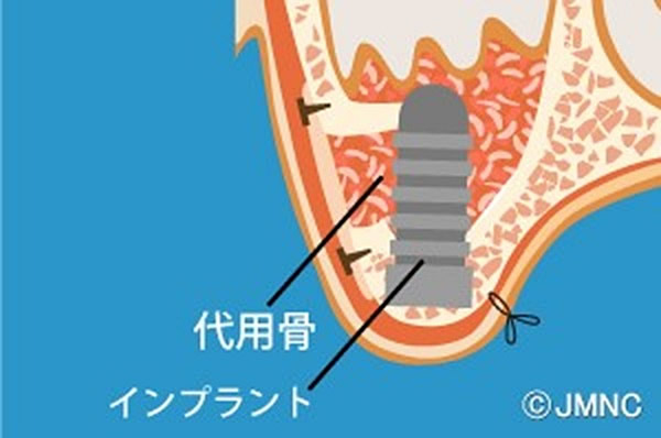 サイナスリフト