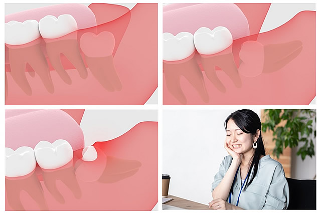 親知らずの抜歯