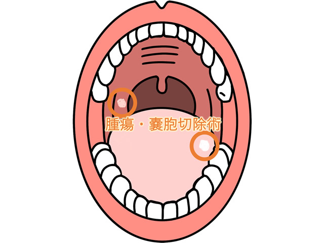 腫瘍・嚢胞切除