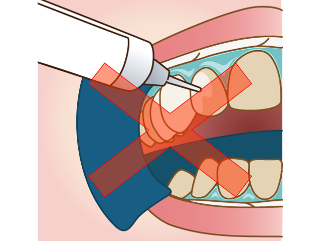 歯肉保護がいらない
