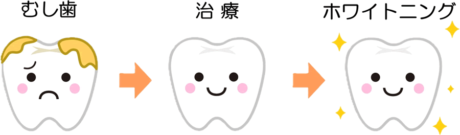 どんな歯でもホワイトニングはできますか？